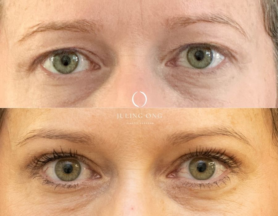 Upper blepharoplasty surgery results
